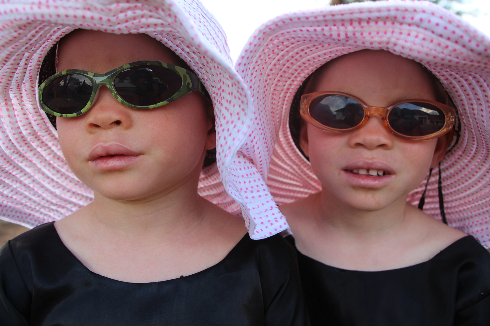 twins with albinism