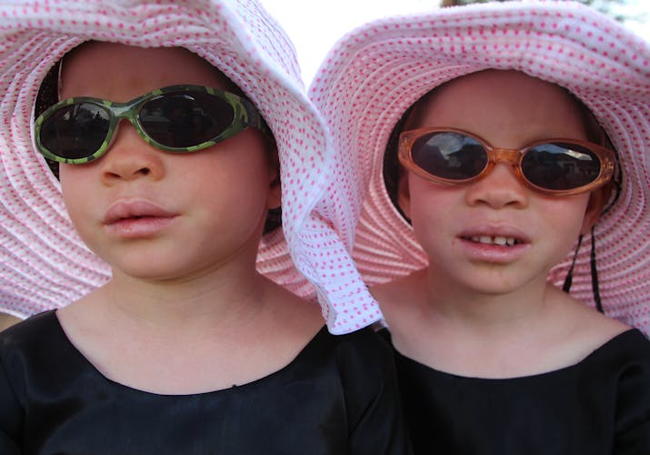 twins with albinism