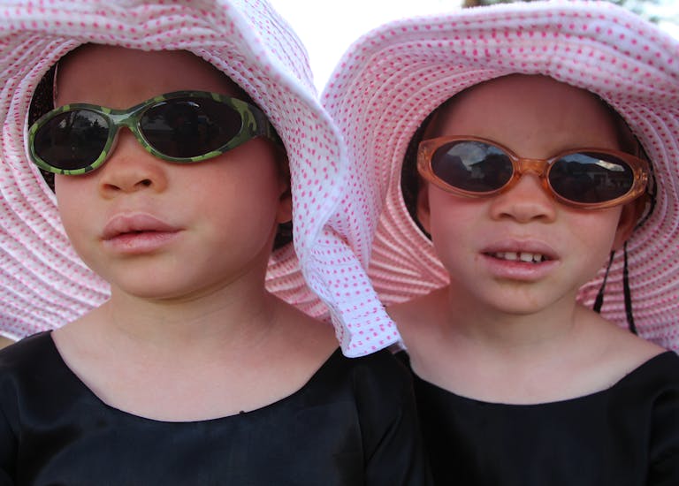 twins with albinism